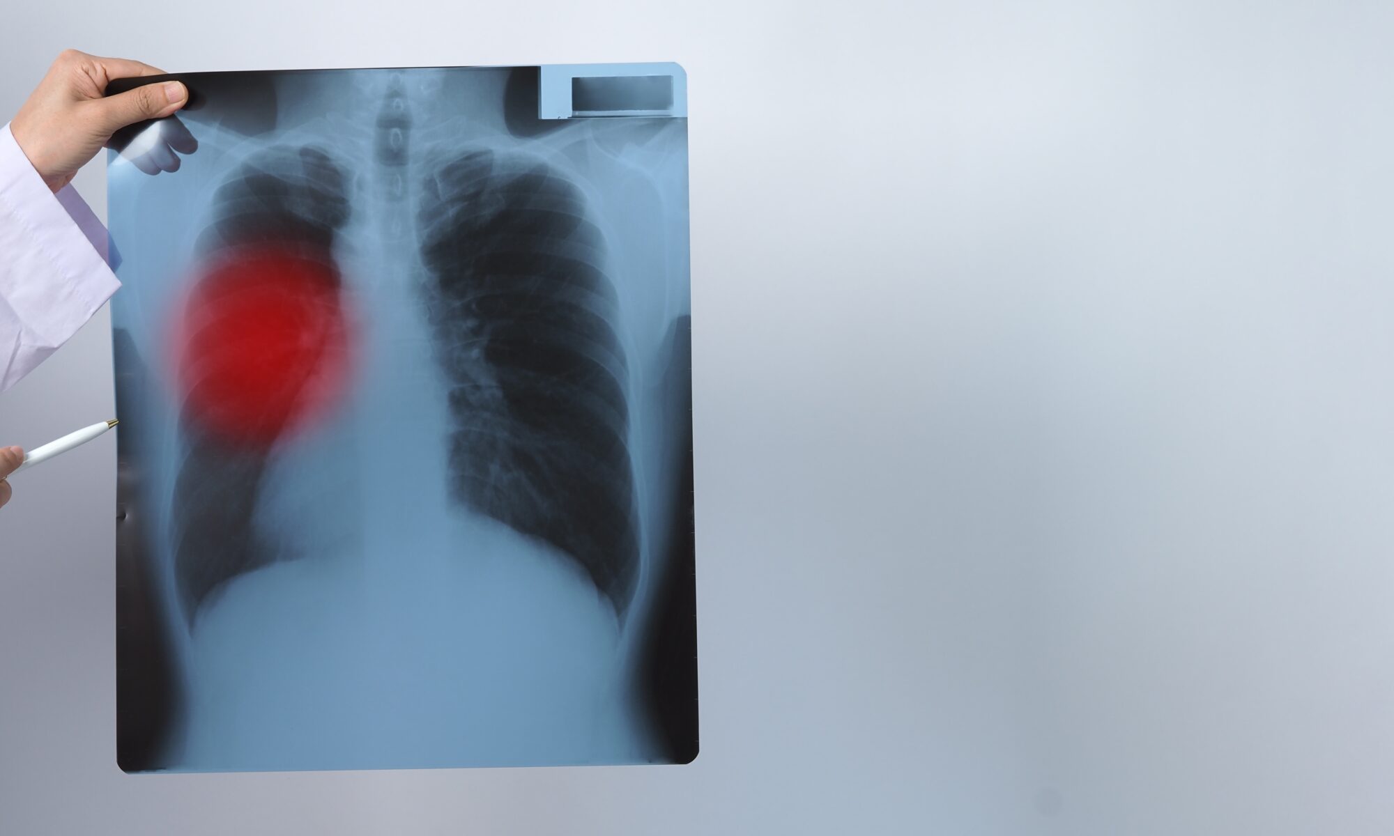 Lung Cancer Screening Assessment Doctor Primary Care
