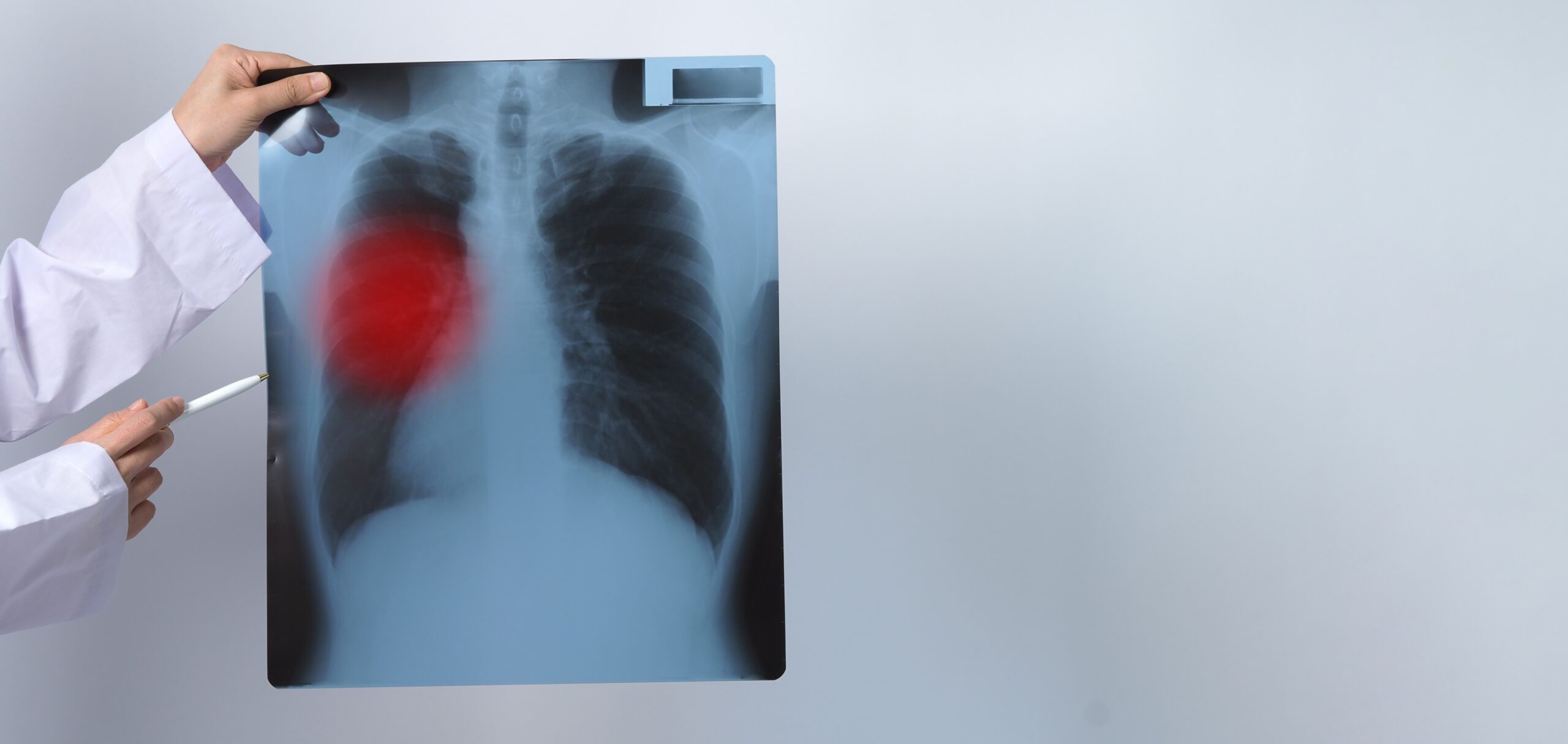 Lung Cancer Screening Assessment Doctor Primary Care